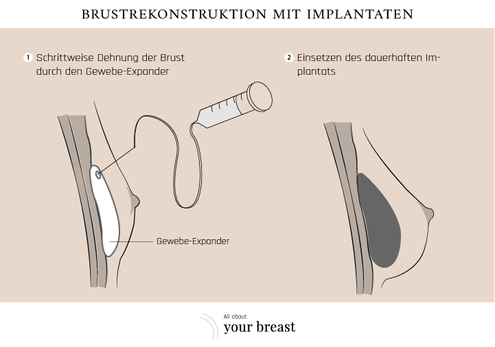 Brustrekonstruktion mit Implantaten 