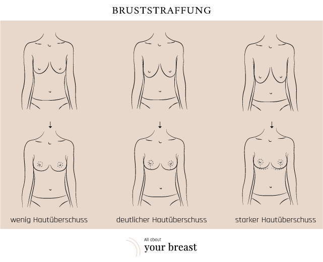 Brust tubuläre Tubuläre Brust