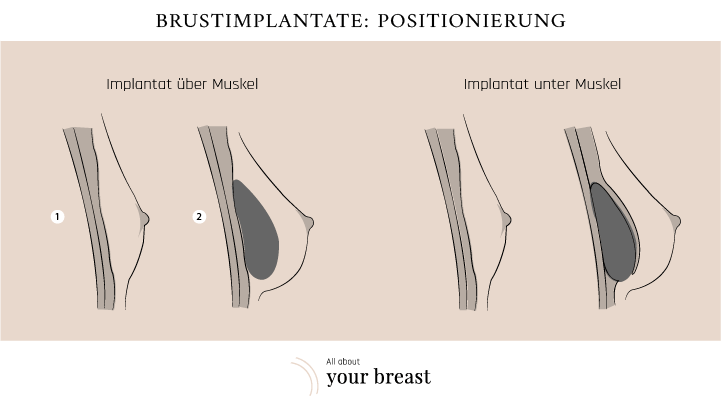 Platzierung Implantat Brustvergrösserung 
