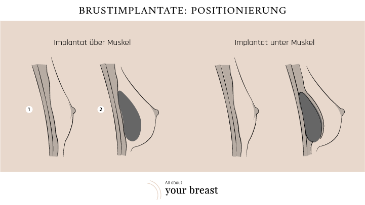 Platzierung Implantat Brustvergrösserung