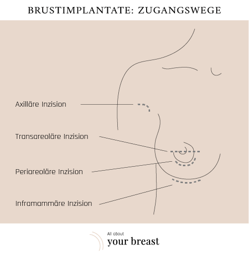 Implantat Zugangswege Brustvergrösserung 