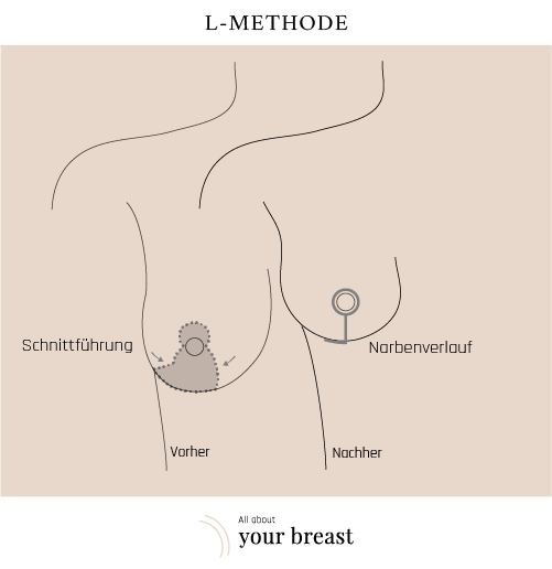 Brustverkleinerung Technik L