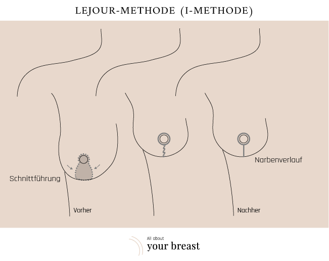 Brustverkleinerung Technik Lejour 