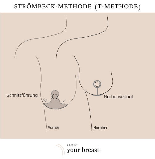 Brustverkleinerung Technik Strömbeck