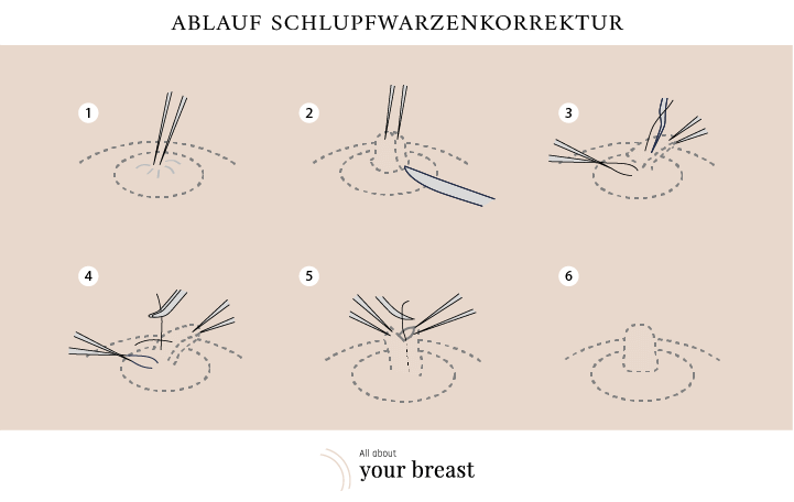 Ablauf OP von Schlupfwarzen 